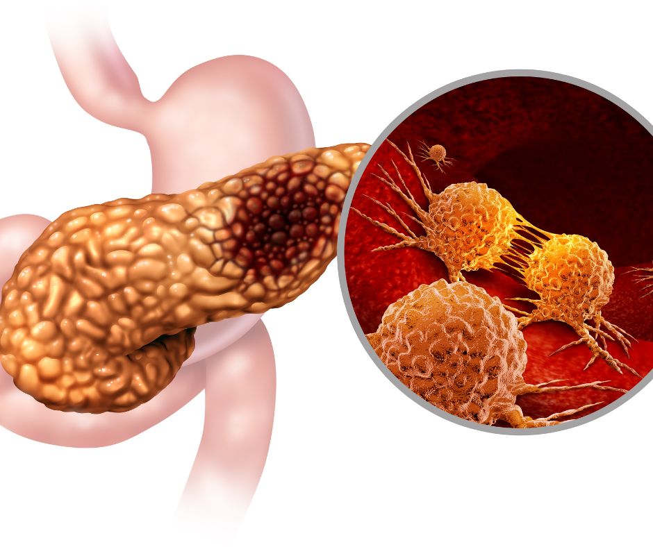 Read more about the article <br>Radiologia intervențională în cancerul pancreatic