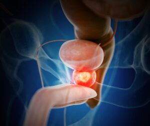 Read more about the article Radiologia intervențională în cancerul de prostată